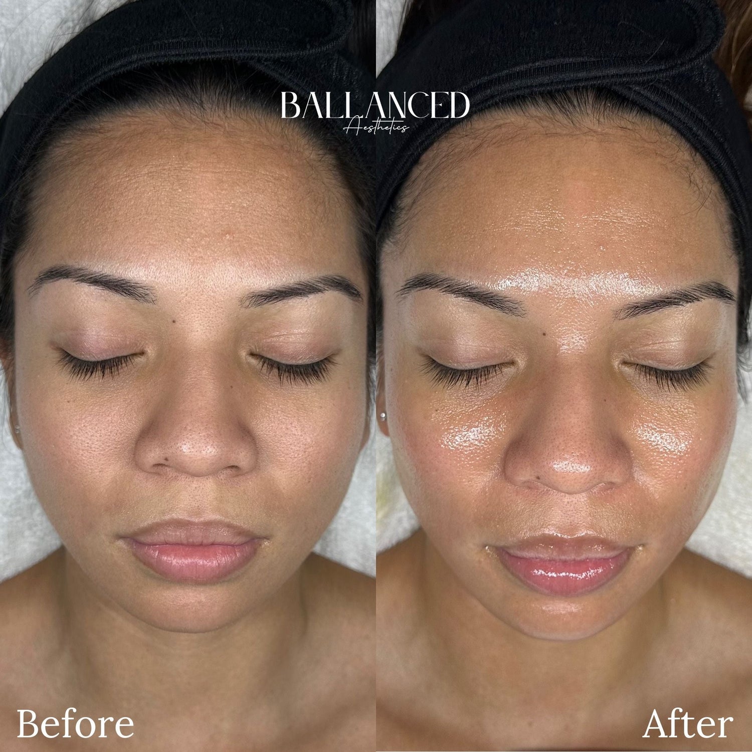 The Balanced Glow: Why Everyone is Obsessed with HydraFacial at Ballanced Aesthetics