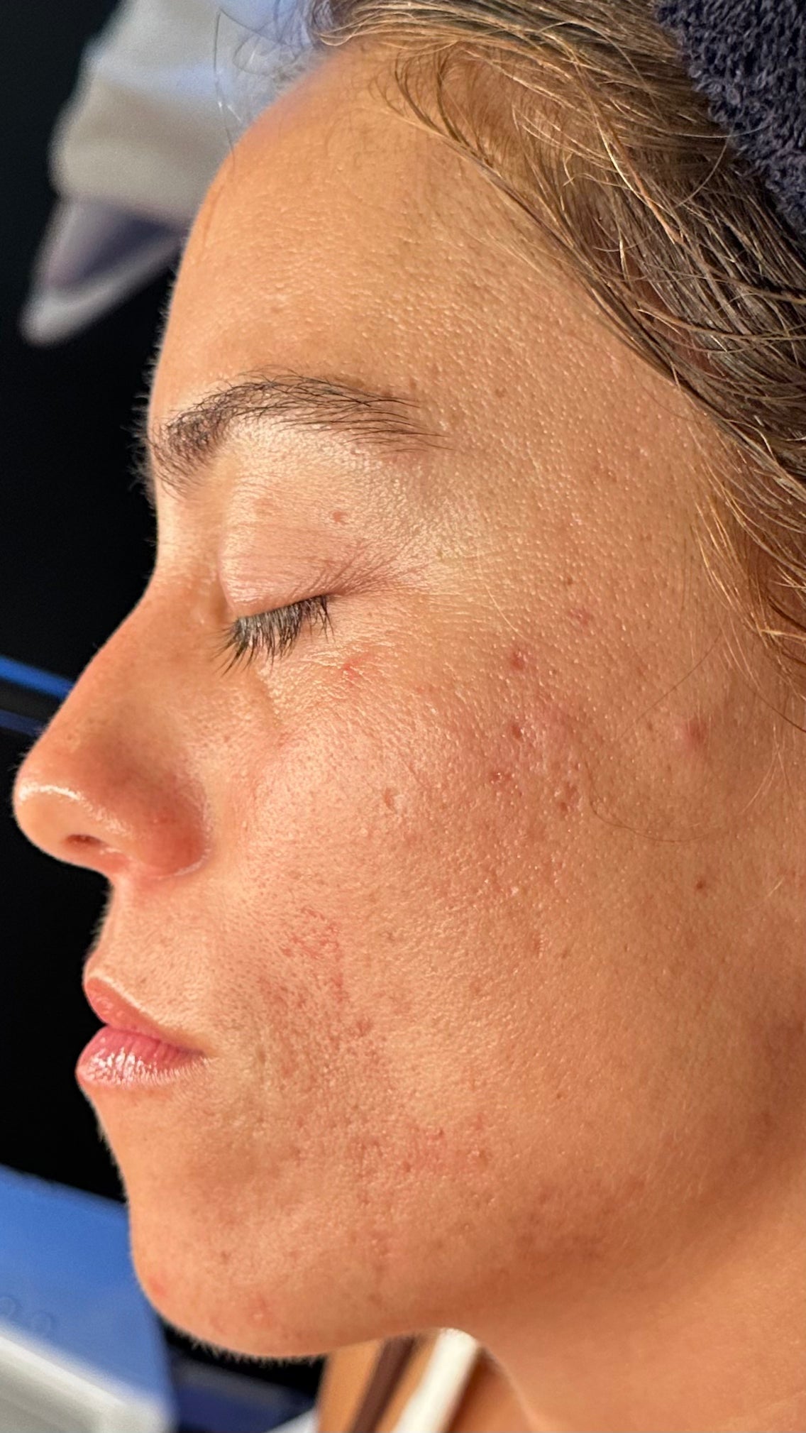 Understanding Acne-Related Hyperpigmentation vs. Scarring