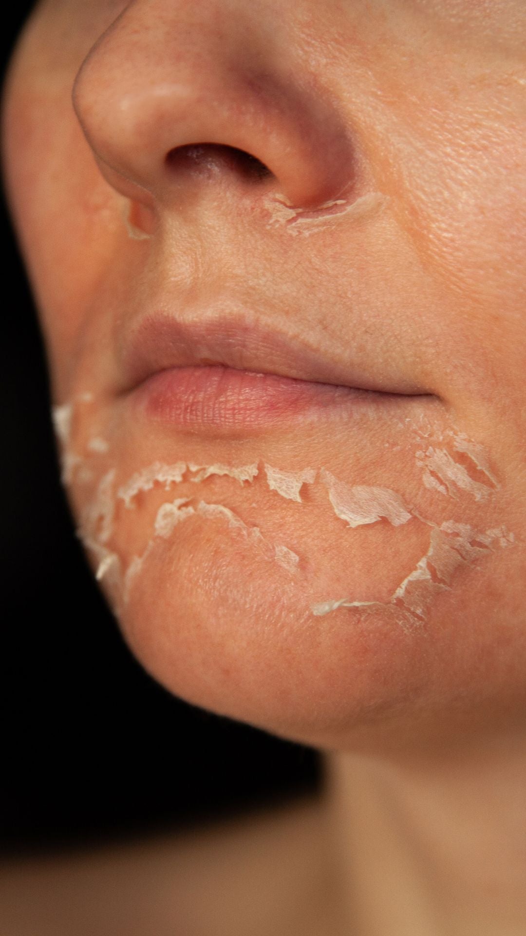 Achieving Your Best Skin: A Guide to Chemical Peels