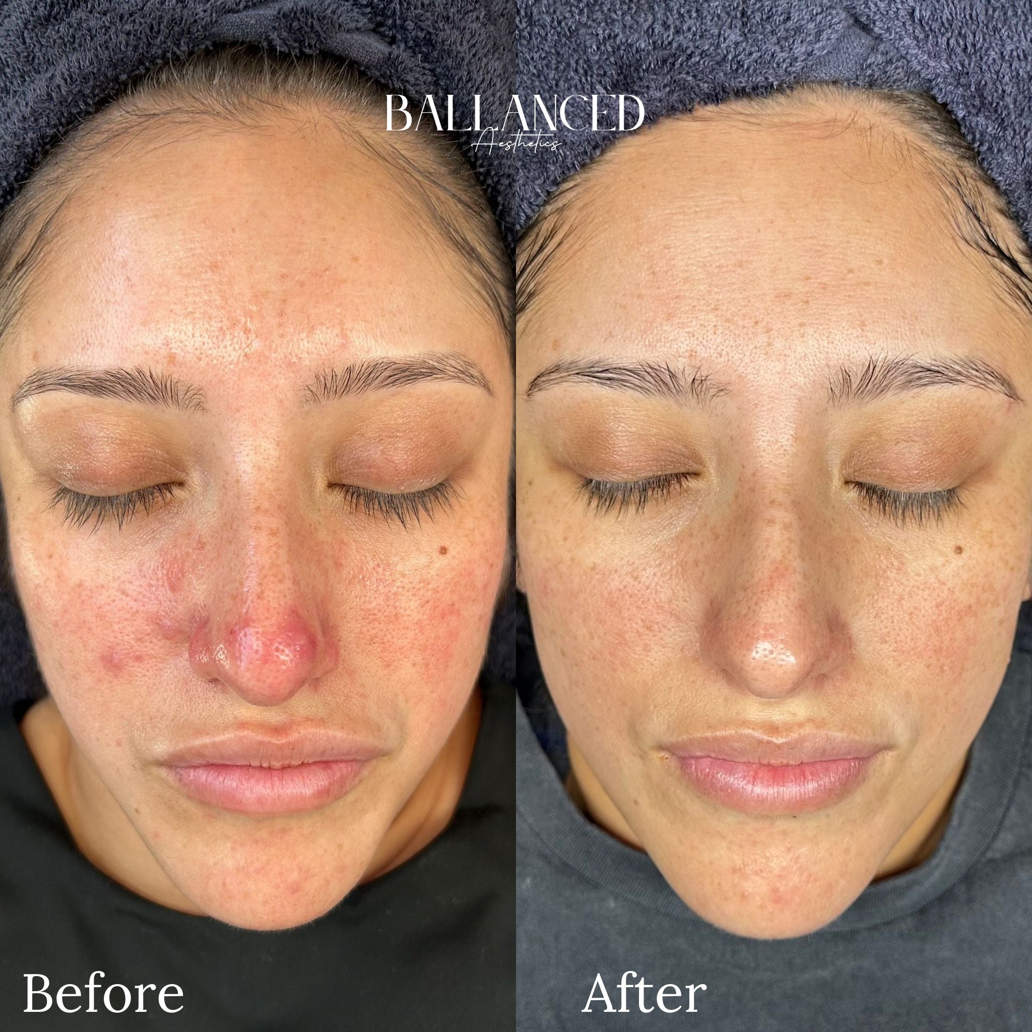 Acne & Rosacea Treatment | Face Reality Skincare – Target breakouts and redness with expert treatments for clear, healthy skin. Book your consultation today!